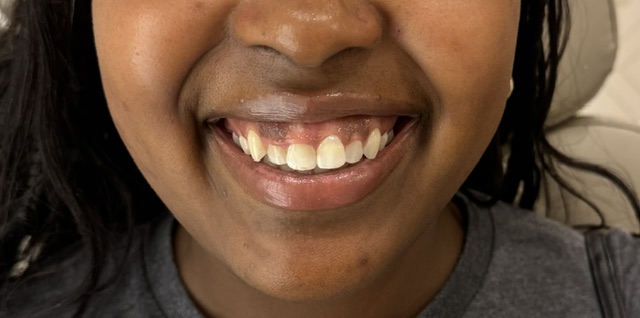 Before Image: Gummy smile correction - front