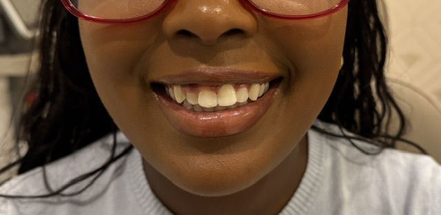 After Image: Gummy smile correction - front
