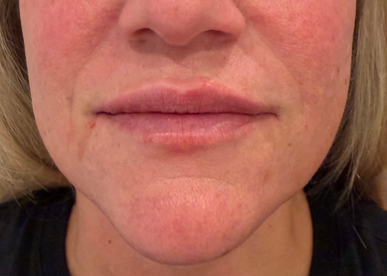 After Image: Lip Filler (click on picture to see gallery) - front