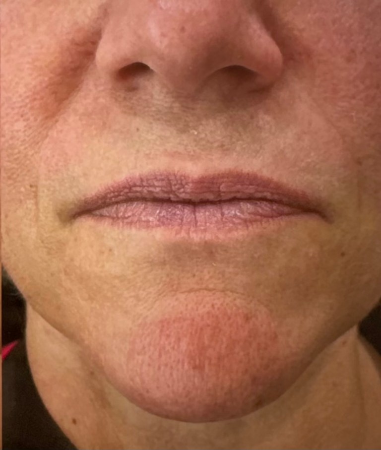 Before Image: Lip Filler (click on picture to see gallery) - front