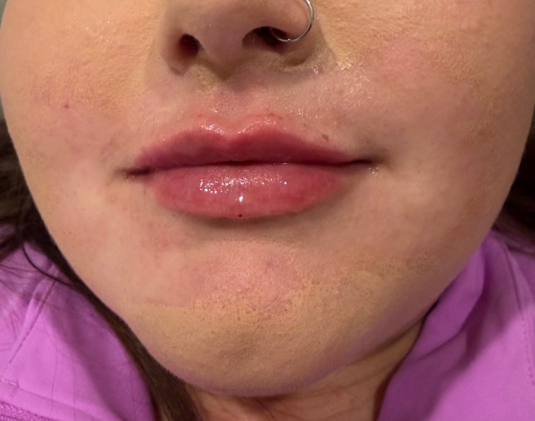 After Image: Lip Filler (click on picture to see gallery) - front