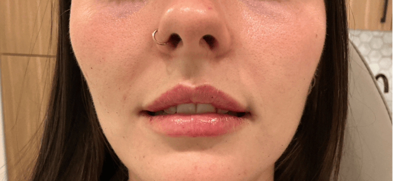 After Image: Lip Filler (click on picture to see gallery) - front