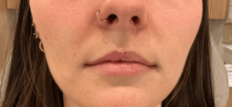 Before Image: Lip Filler (click on picture to see gallery) - front