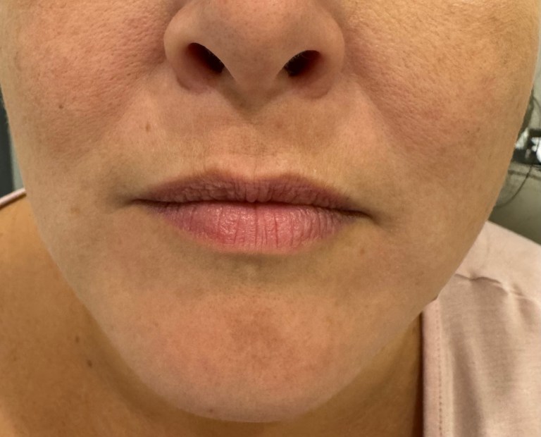 Before Image: Lip Filler (click on picture to see gallery) - front