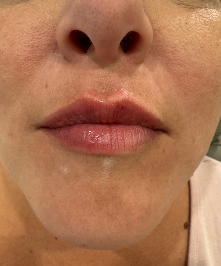 After Image: Lip Filler (click on picture to see gallery) - front