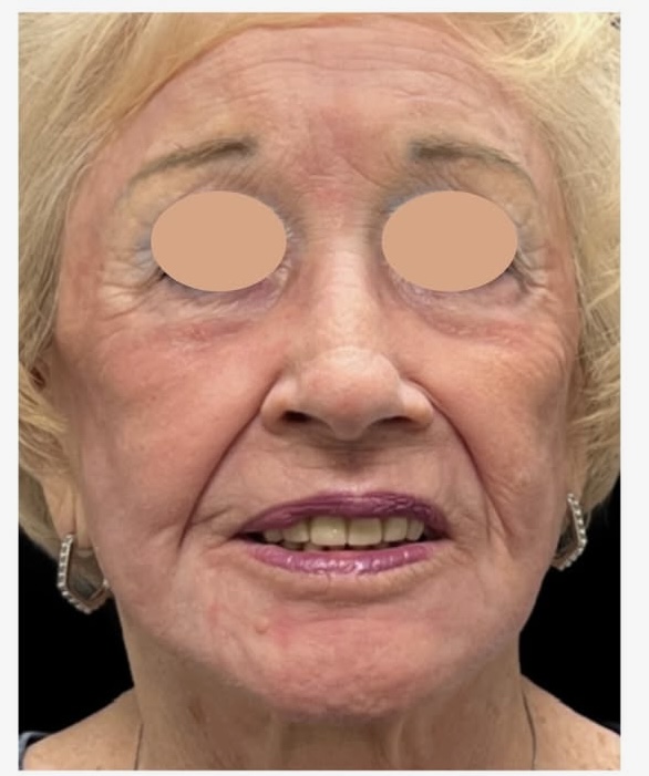 After Image: HELIX Laser Skin Resurfacing | Advanced CO₂ Laser Treatment in Monroe, NC - front