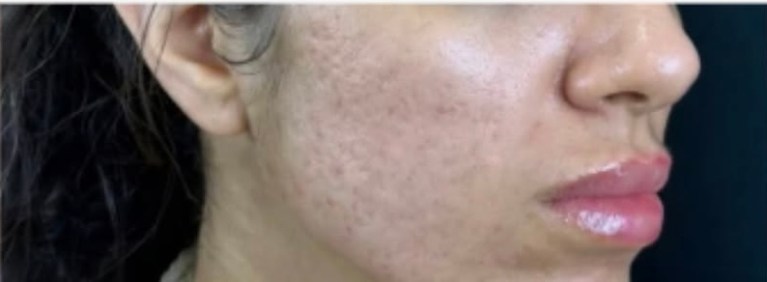 After Image: HELIX Laser Skin Resurfacing | Advanced CO₂ Laser Treatment in Monroe, NC - front
