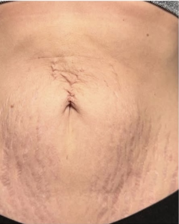 Before Image: HELIX Laser Skin Resurfacing | Advanced CO₂ Laser Treatment in Monroe, NC - front