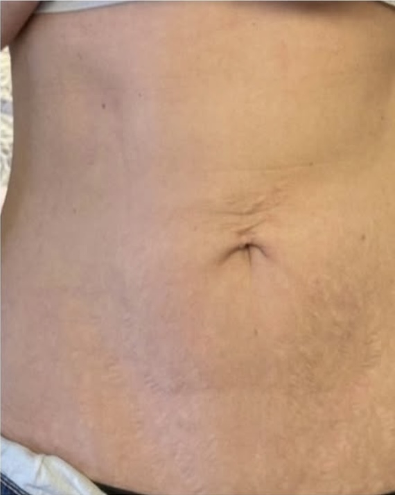 After Image: HELIX Laser Skin Resurfacing | Advanced CO₂ Laser Treatment in Monroe, NC - front