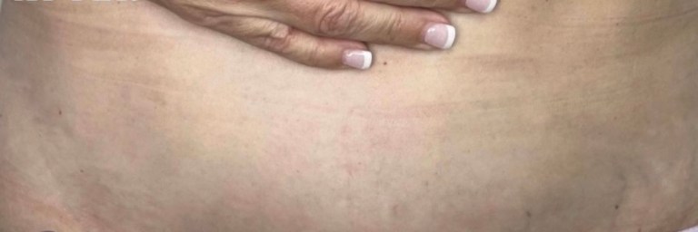 After Image: HELIX Laser Skin Resurfacing | Advanced CO₂ Laser Treatment in Monroe, NC - front