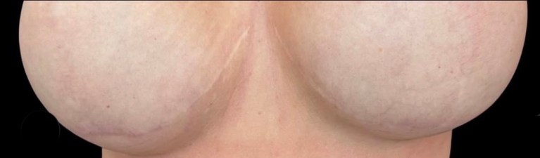 After Image: HELIX Laser Skin Resurfacing | Advanced CO₂ Laser Treatment in Monroe, NC - front