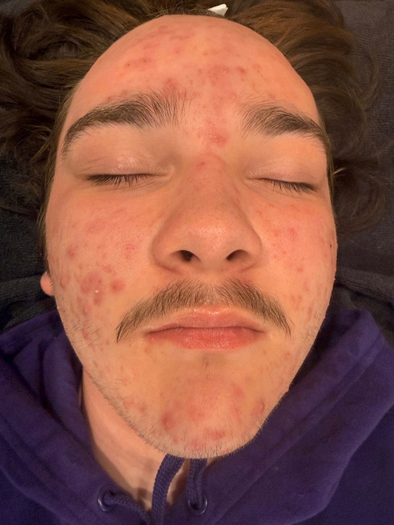 Before Image: Acne Boot Camp (Click on photo to see gallery) - front