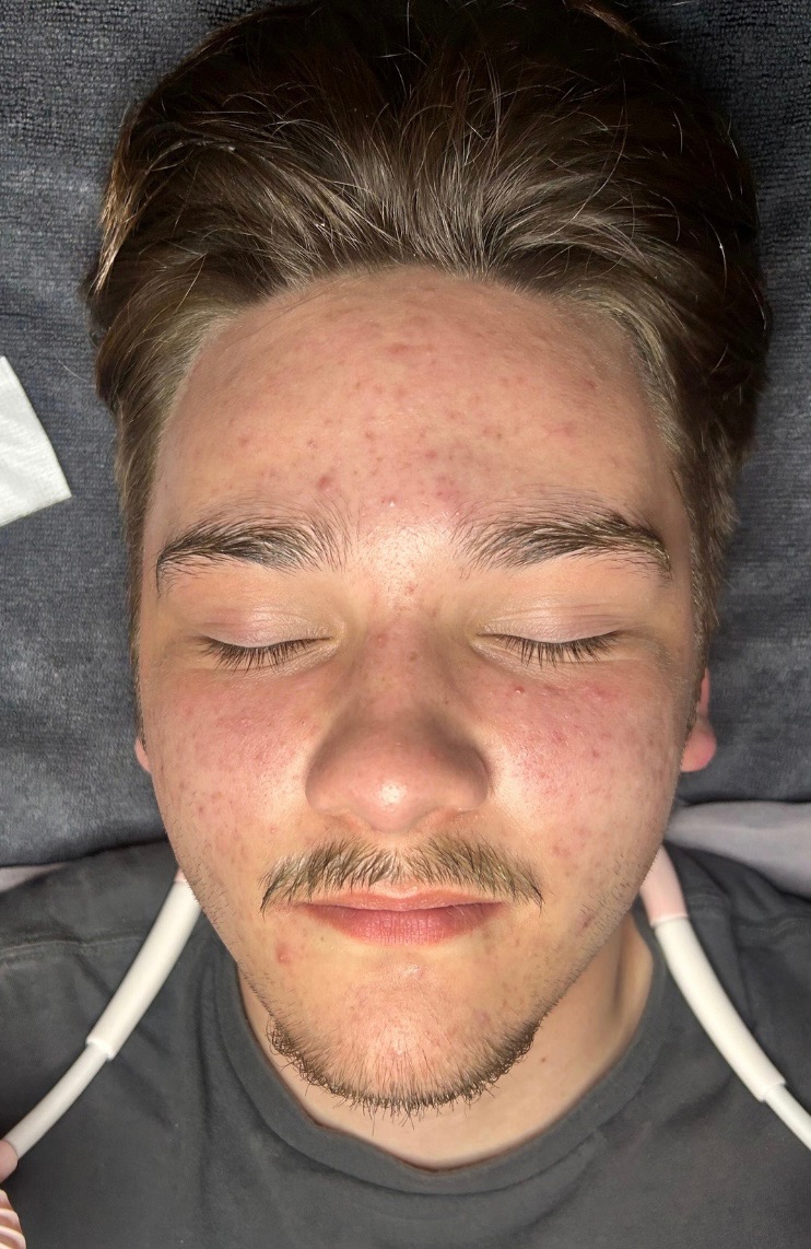 After Image: Acne Boot Camp (Click on photo to see gallery) - front