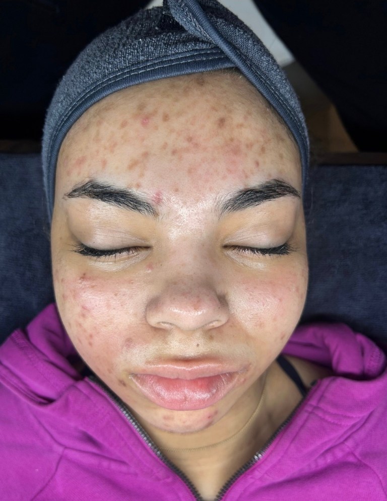 Before Image: Acne Boot Camp (Click on photo to see gallery) - front